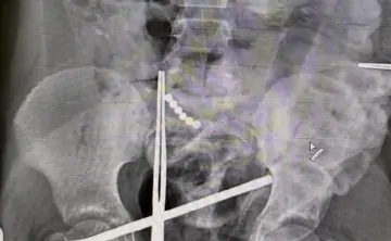 Магниты в кишечнике. Фото ГБУ РО "ОДКБ"