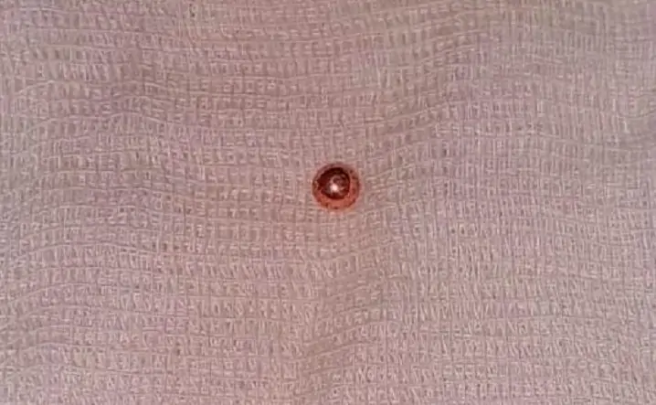 Пуля. Фото из Telegram-канала министерства здравоохранения Ростовской области